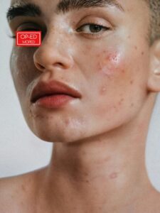 Shingles, or herpes zoster, is a painful rash caused by the reactivation of the varicella-zoster virus—the same virus responsible for chickenpox.